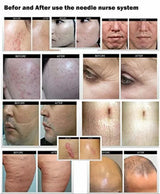 540 Dermaroller Micro Needle for Wrinkles, Anti-aging, Deep Scars, Cellulite, Beard & Hair Growth